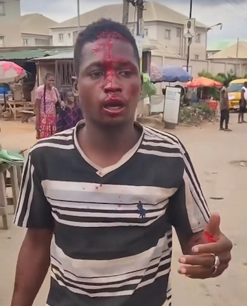 Al-Hassan Usman, an Okada rider brutalized by policemen enforcing Okada ban at Abule Egba area now bedridden