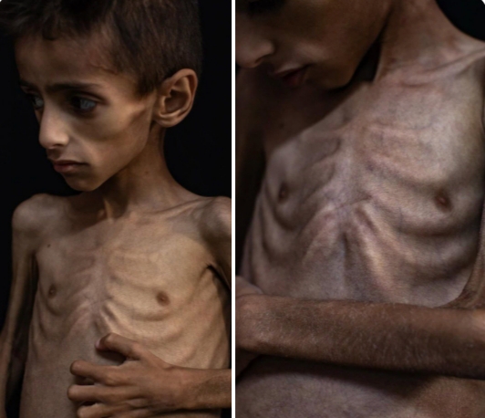 How Netanyahu is using starvation as an instrument to decimate Gaza Pictures of starvation from Gaza